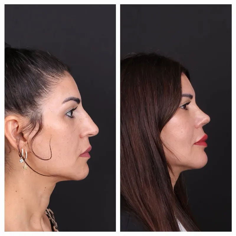 Before and after deep plane facelift — -1-year-old patient, frontal view by Dr. Oğuzhan Aydoğdu