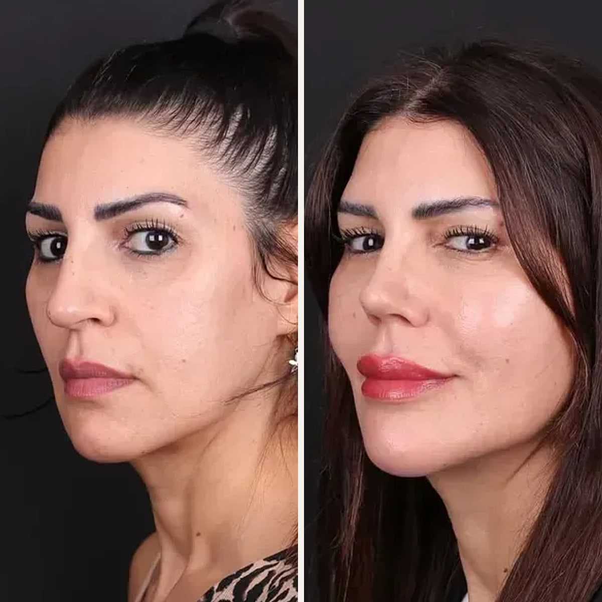 Before and after: Dr. Oğuzhan Aydoğdu