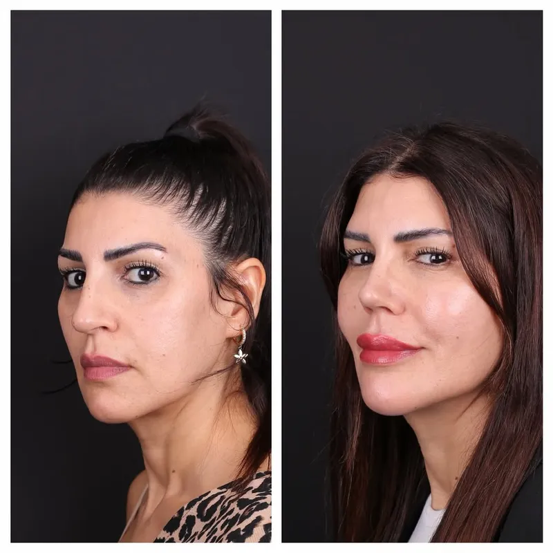 Before and after deep plane facelift — -1-year-old patient, frontal view by Dr. Oğuzhan Aydoğdu