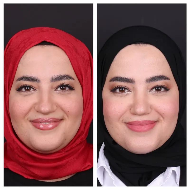 Before and after deep plane facelift — -1-year-old patient, frontal view by Dr. Oğuzhan Aydoğdu