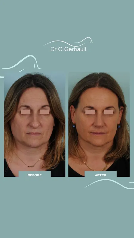 Before and after — Dr. Olivier Gerbault
