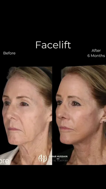 Before and after deep plane facelift, frontal view by Dr. Omar Hussain