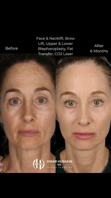 Before and after deep plane facelift, frontal view by Dr. Omar Hussain
