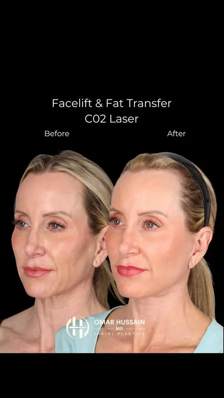Before and after deep plane facelift, frontal view by Dr. Omar Hussain