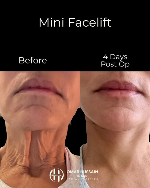 Before and after deep plane facelift, frontal view by Dr. Omar Hussain