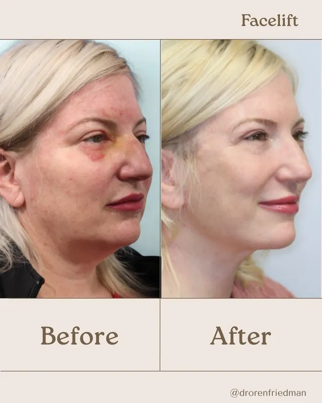 Before and after — Dr. Oren Friedman