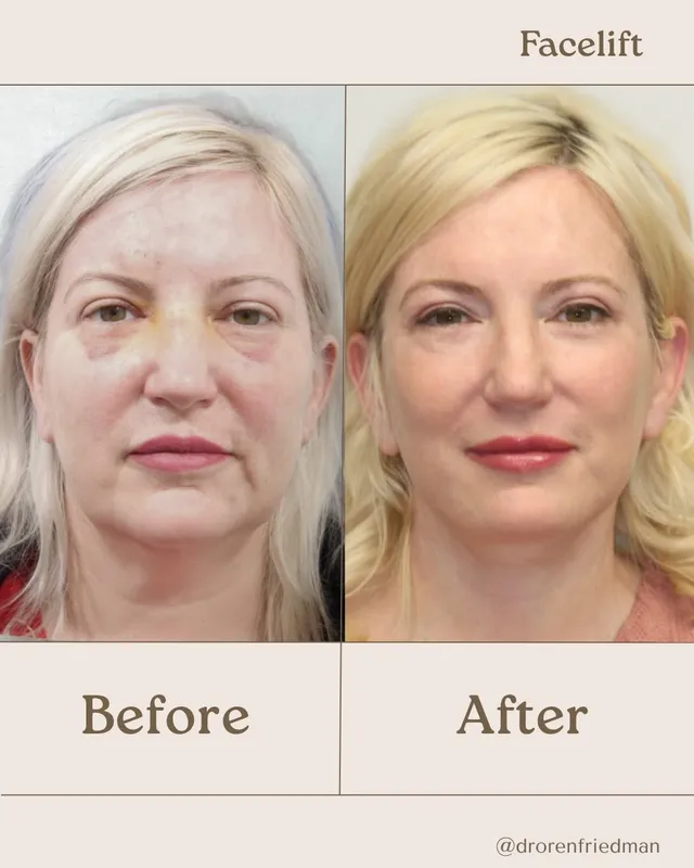 Before and after — Dr. Oren Friedman