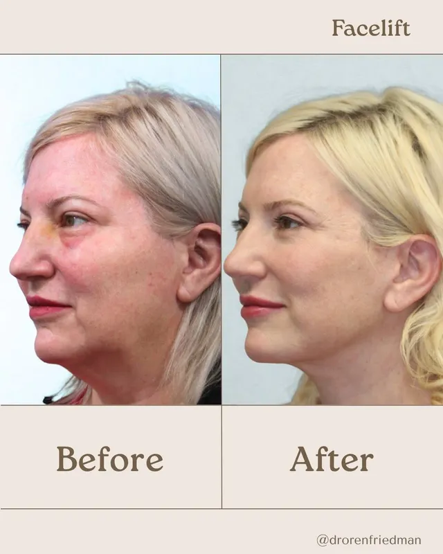 Before and after — Dr. Oren Friedman