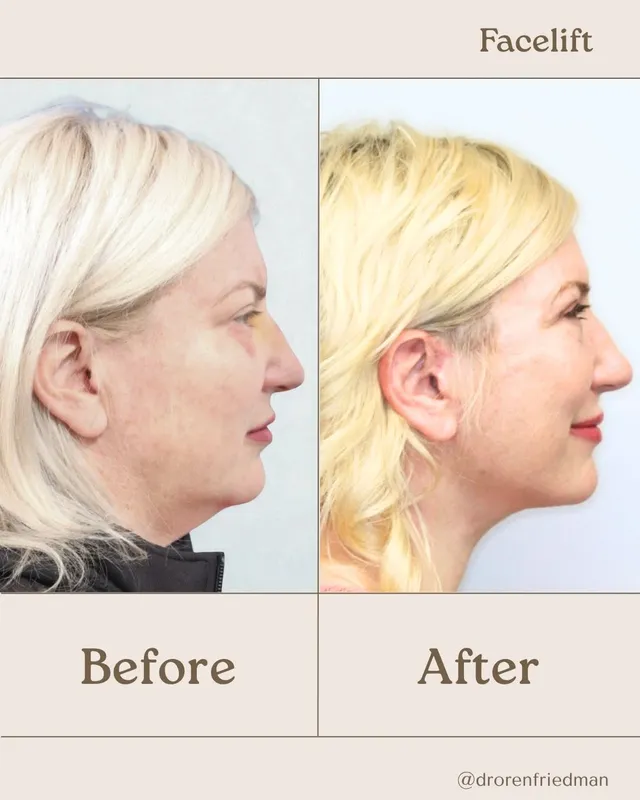 Before and after — Dr. Oren Friedman