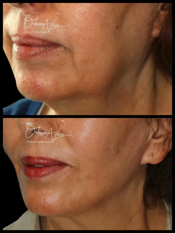 Before and after deep plane facelift, frontal view by Dr. Orhan Aydın