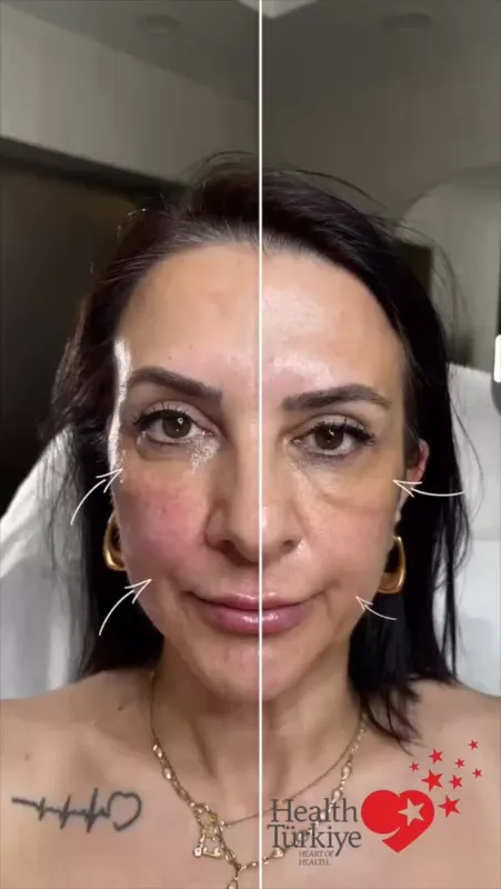 Before and after — Dr. Ozan Balık