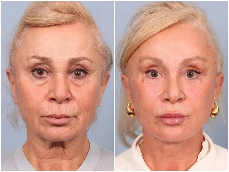 Before and after — Dr. Ozan Bitik
