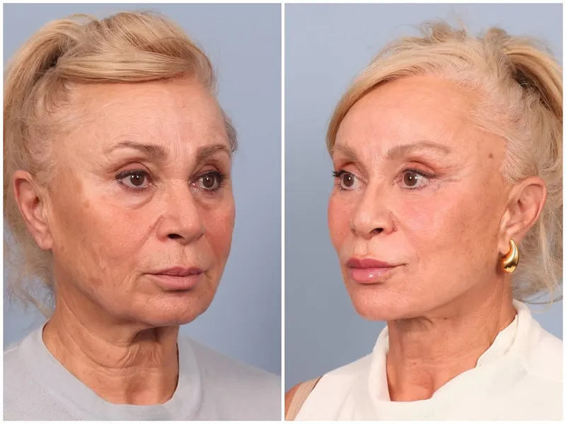 Before and after — Dr. Ozan Bitik
