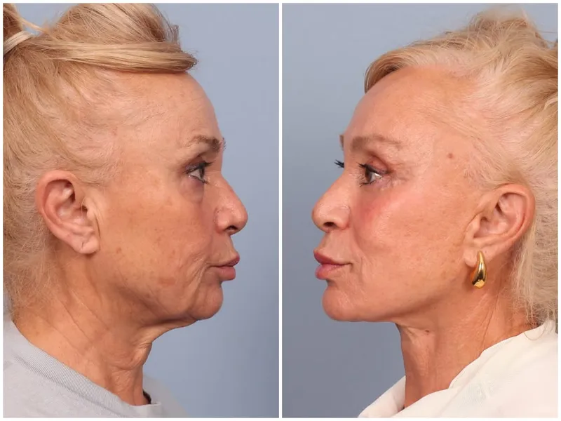 Before and after — Dr. Ozan Bitik