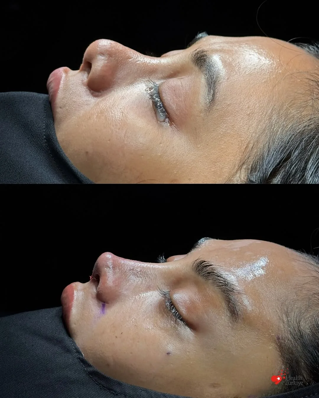Before and after — Dr. Ozan Erol