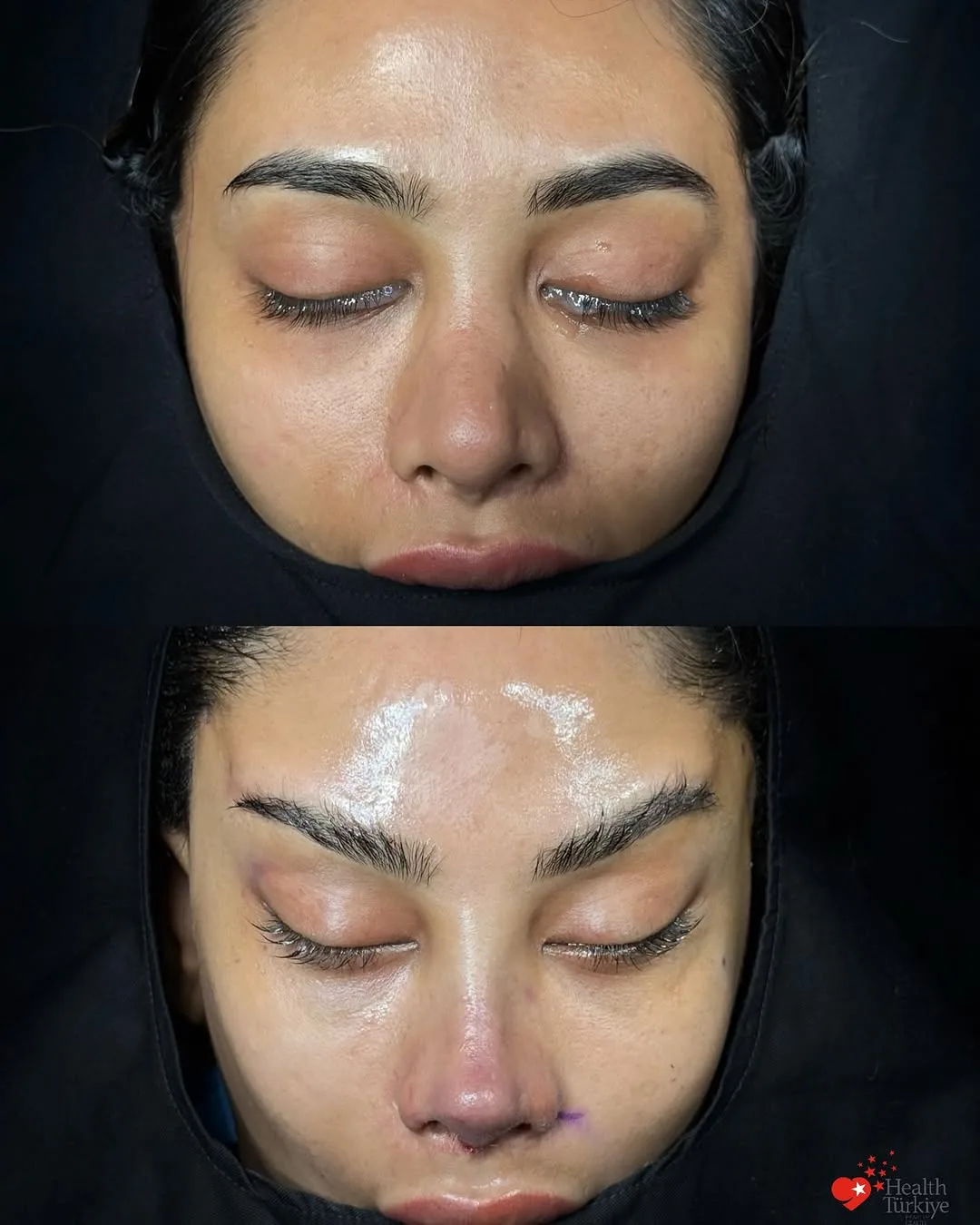 Before and after — Dr. Ozan Erol