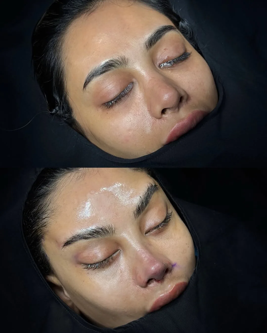 Before and after — Dr. Ozan Erol