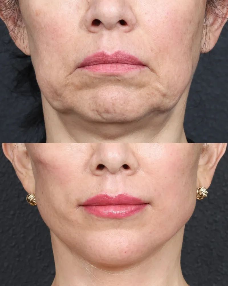 Before and after — Dr. Ozan Sozer