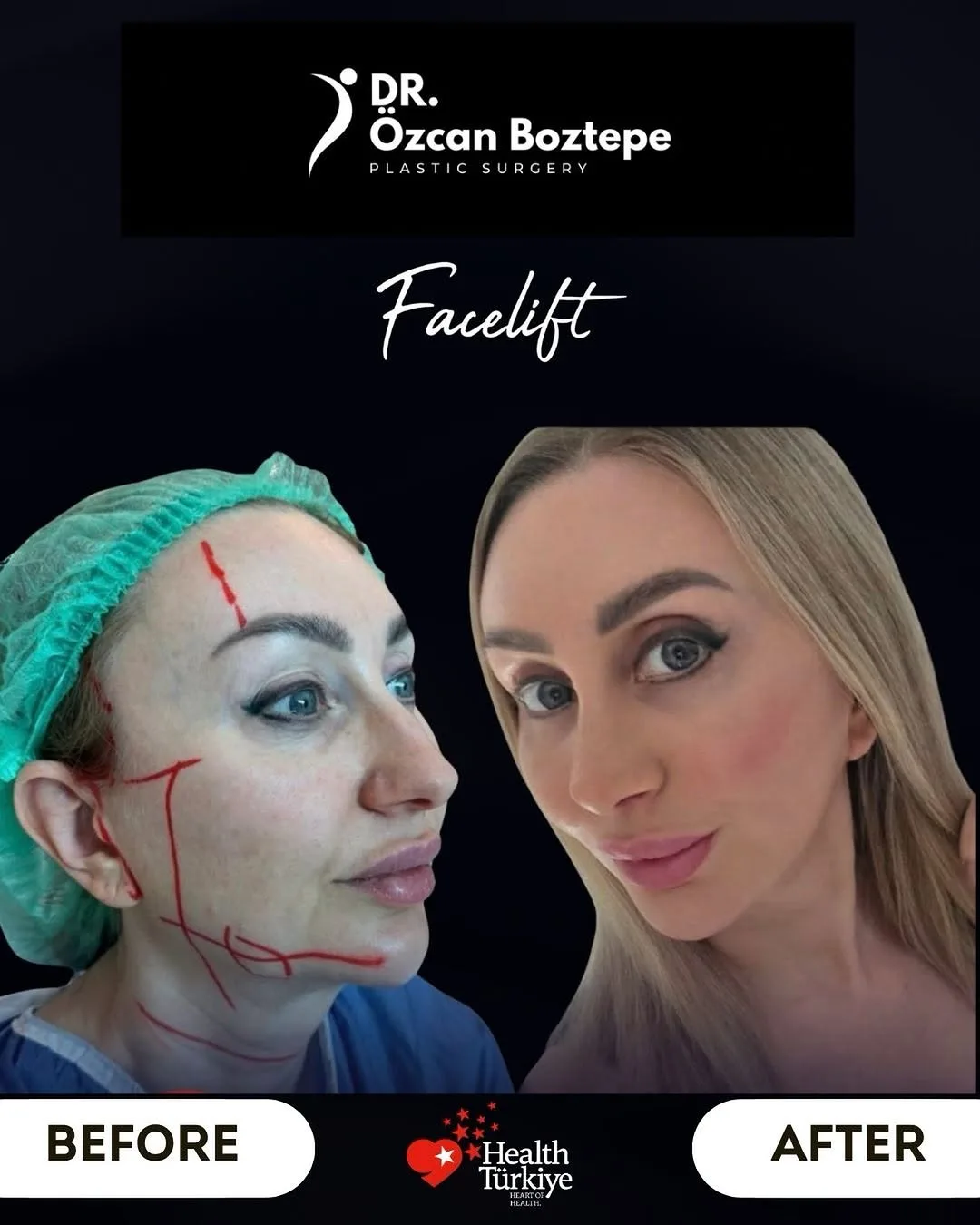 Before and after — Dr. Ozcan Boztepe