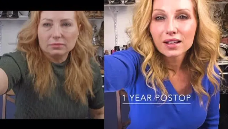 Before and after — Dr. Özcan Çakmak
