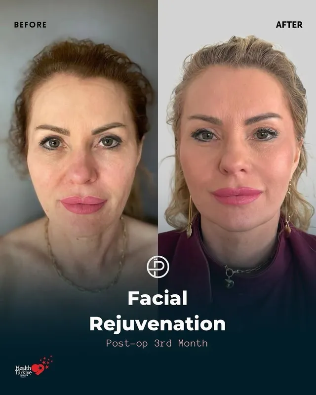 Before and after — Prof. Özgür Pilancı