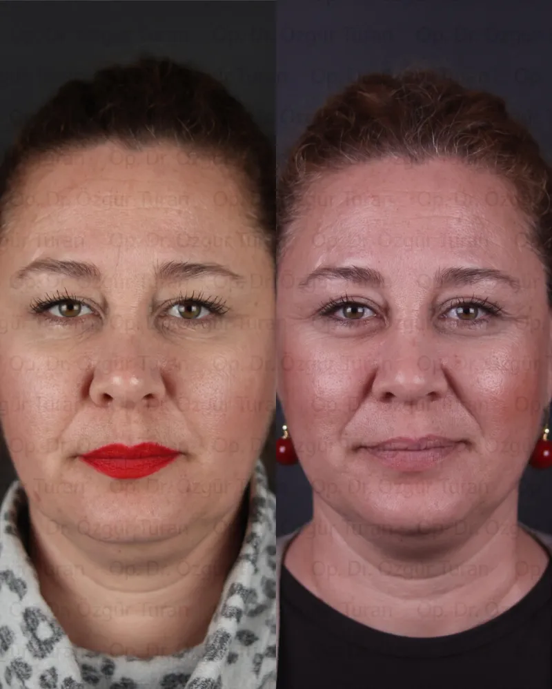 Before and after — Dr. Özgür Turan