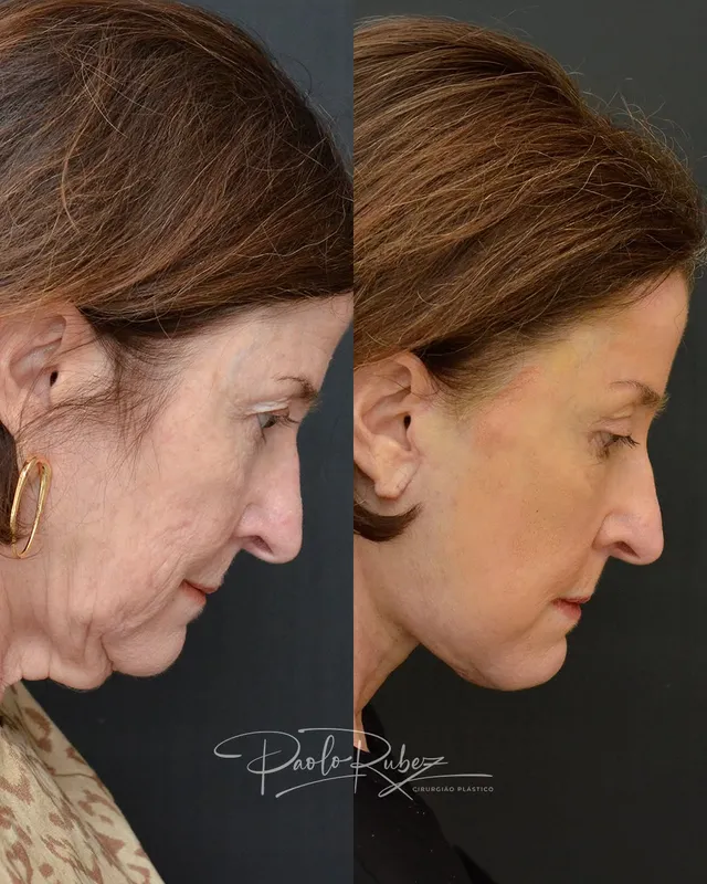 Before and after — Dr. Paolo Rubez