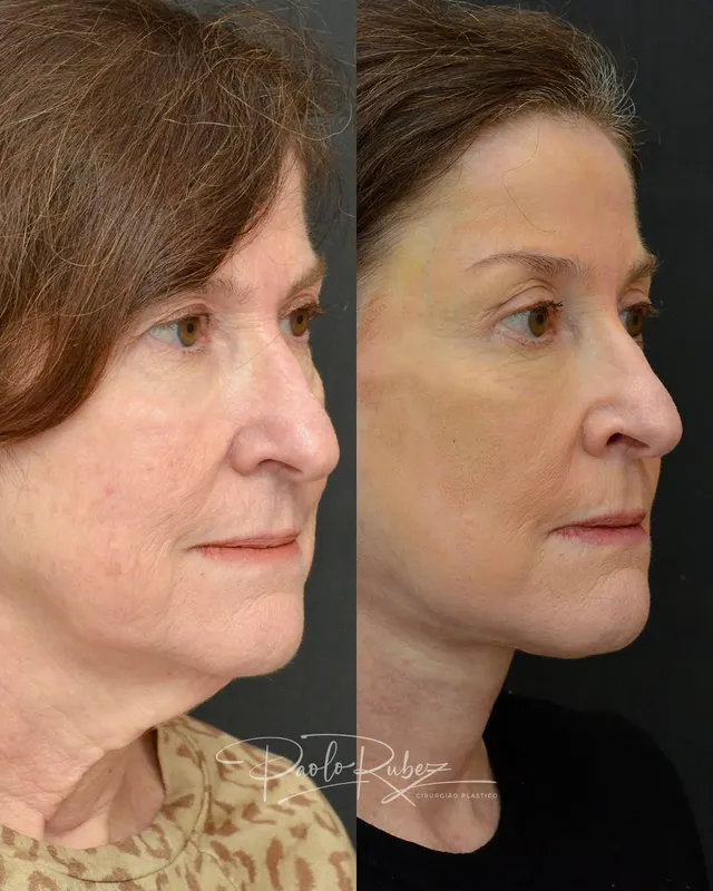Before and after — Dr. Paolo Rubez