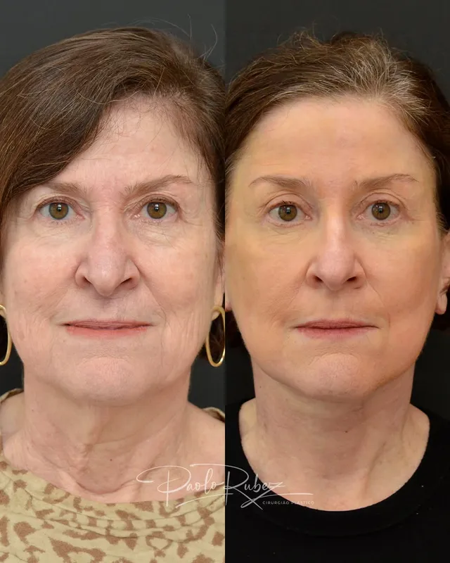 Before and after — Dr. Paolo Rubez