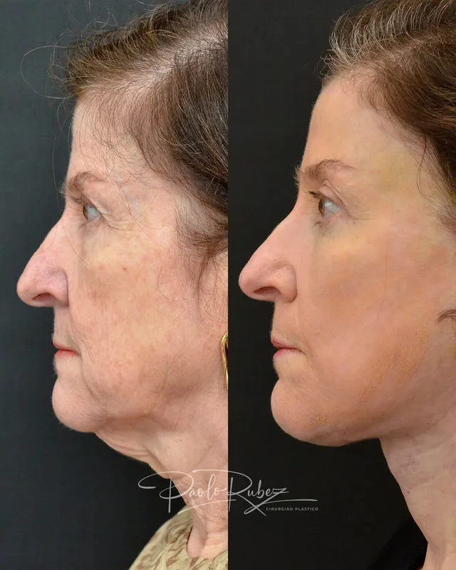 Before and after — Dr. Paolo Rubez