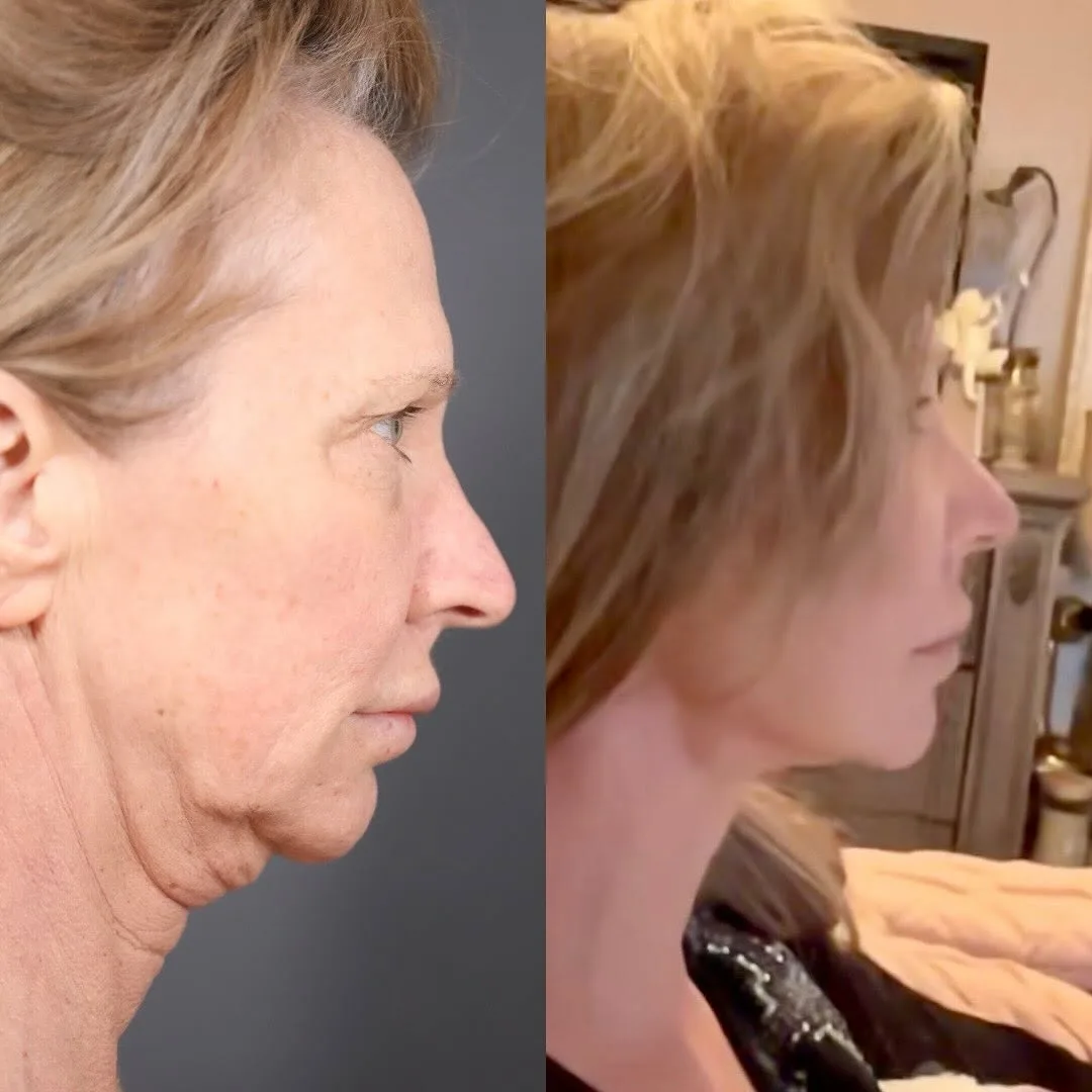 Before and after — Dr. Parsa Salehi
