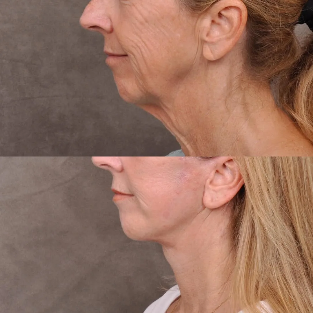 Before and after — Dr. Parsa Salehi