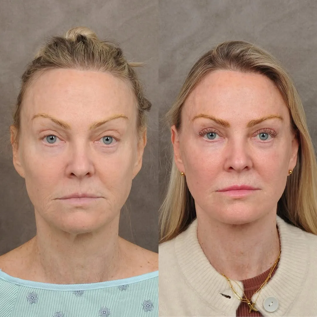 Before and after — Dr. Parsa Salehi