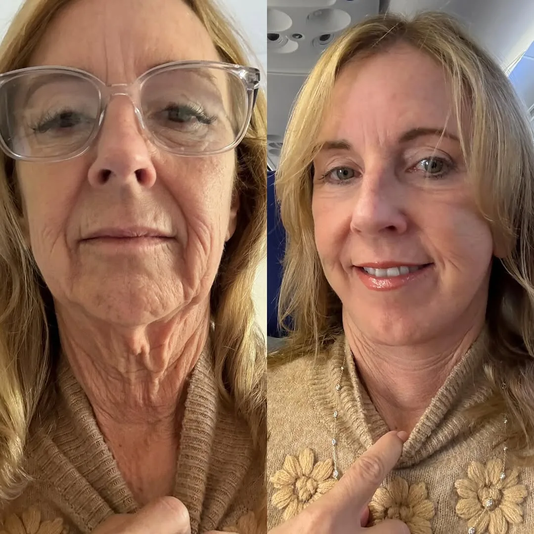Before and after — Dr. Parsa Salehi