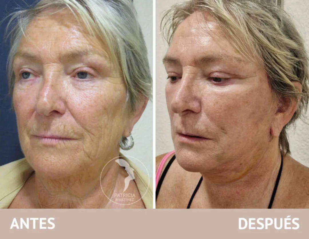 Before and after — Dr. Patricia Martínez