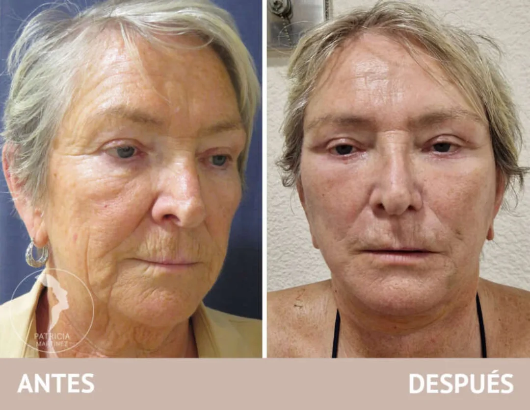 Before and after — Dr. Patricia Martínez