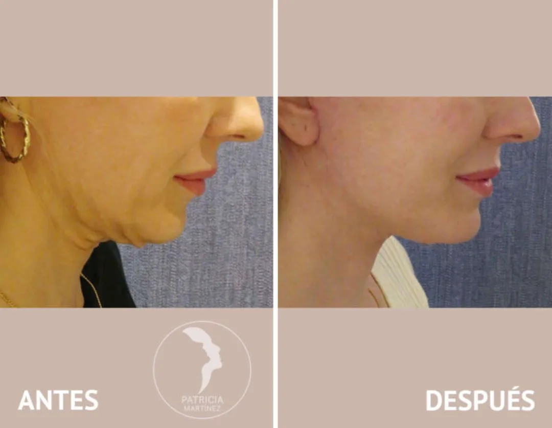 Before and after — Dr. Patricia Martínez