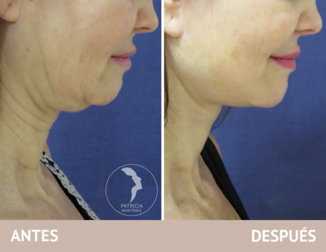 Before and after — Dr. Patricia Martínez