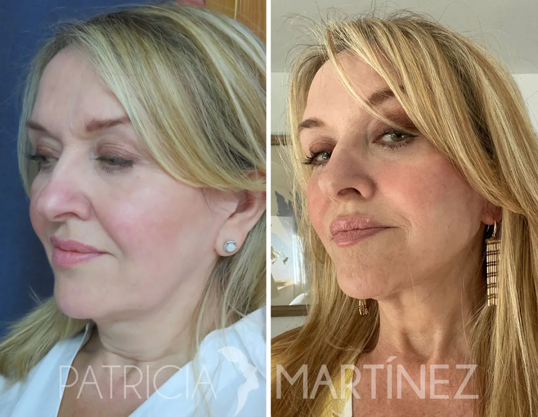 Before and after — Dr. Patricia Martínez