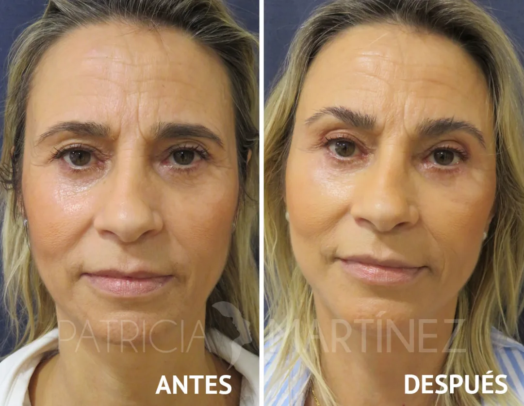 Before and after: Dr. Patricia Martínez