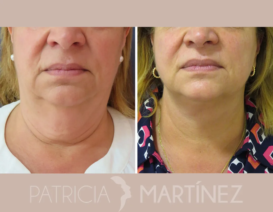 Before and after — Dr. Patricia Martínez