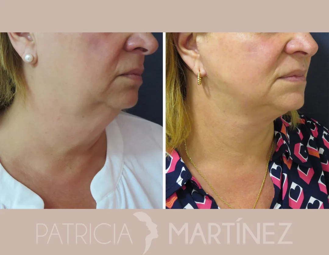 Before and after — Dr. Patricia Martínez