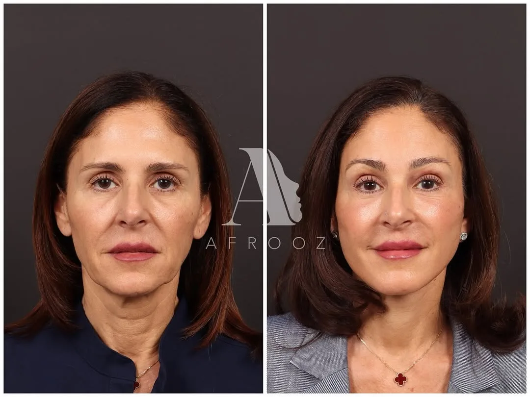 Before and after deep plane facelift — 52-year-old woman, frontal view, 7mo post-op by Dr. Paul Afrooz