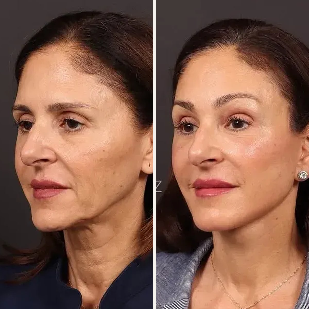 Before and after: Dr. Paul Afrooz