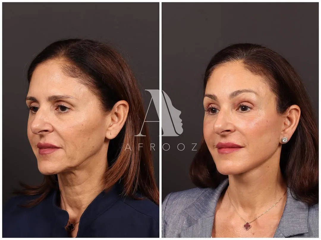 Before and after deep plane facelift — 48-year-old woman, left profile view, 6mo post-op by Dr. Paul Afrooz