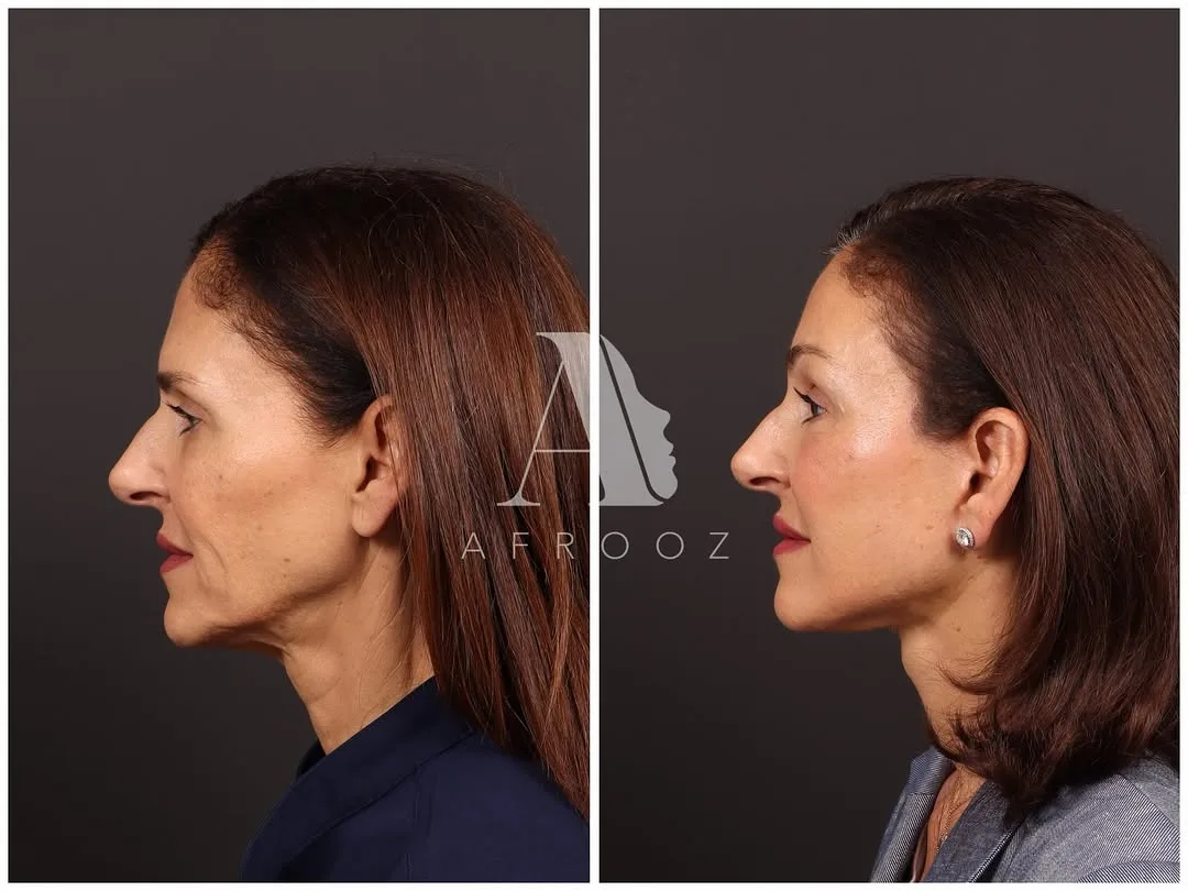 Before and after deep plane facelift — 45-year-old woman, left profile view, 9mo post-op by Dr. Paul Afrooz