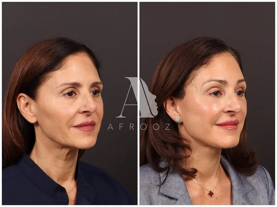Before and after deep plane facelift — 48-year-old woman, oblique right view, 6mo post-op by Dr. Paul Afrooz