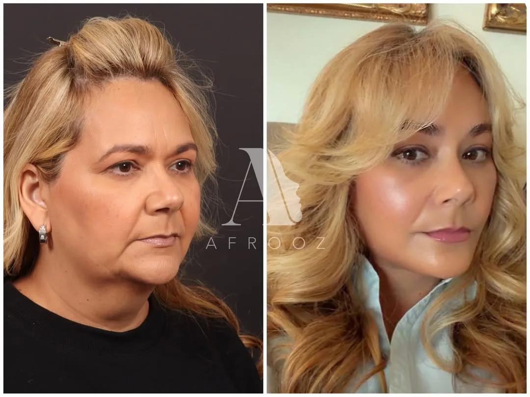 Before and after deep plane facelift — 54-year-old woman, oblique left view, 9mo post-op by Dr. Paul Afrooz