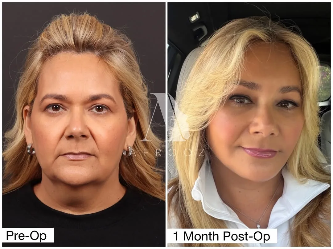 Before and after deep plane facelift — 52-year-old woman, oblique right view, 1mo post-op by Dr. Paul Afrooz