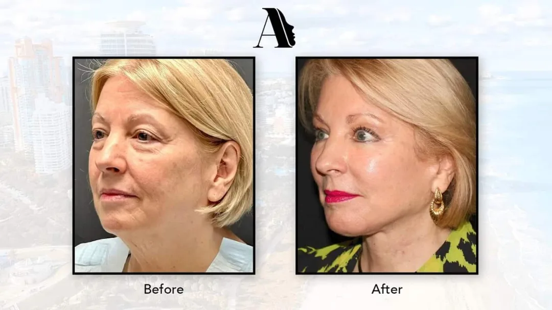 Before and after deep plane facelift — 58-year-old woman, three-quarter view, 6mo post-op by Dr. Paul Afrooz